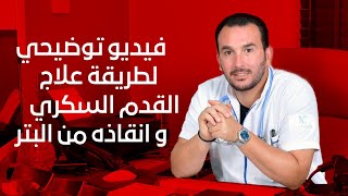 اكتشفوا طرق علاج القدم السكري و انقاذه من البتر مع الدكتور حمزة بنجلون