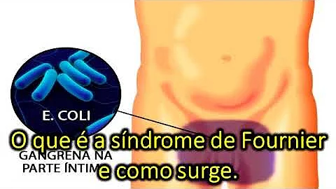O que é doença de Fournier?