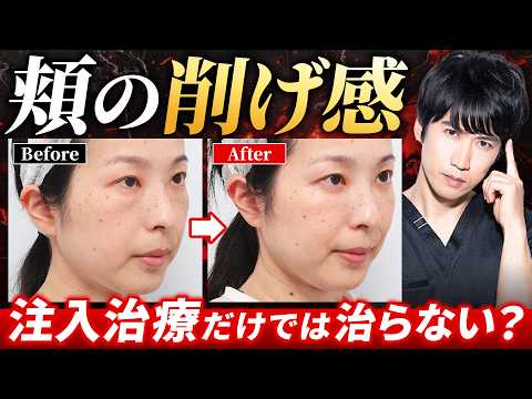 頬の削げ感はどう治す？頬を“持ち上げる”という選択肢【裏ミッドフェイスリフト】