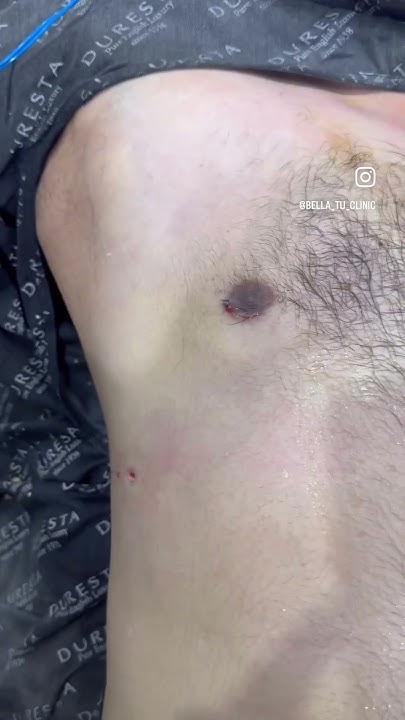 gynecomastia-surgery-in-pakistan-lahore-by-dr-saleem-gyno