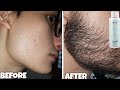 Mars minoxidil का सच किया सिर्फ 2 महीने इस तरह का दाढ़ी आ जायेगी | mars minoxidil review |