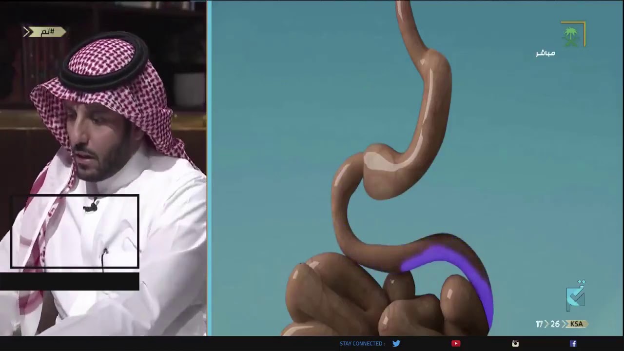 #تم | كيف تتم عملية تحويل المسار للمعدة؟ .. مع د. حمد السبيعي.