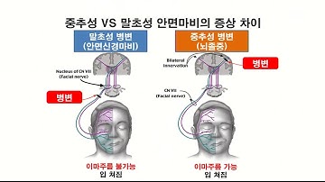 [톡톡건강토크] 입돌아가는 병,안면마비