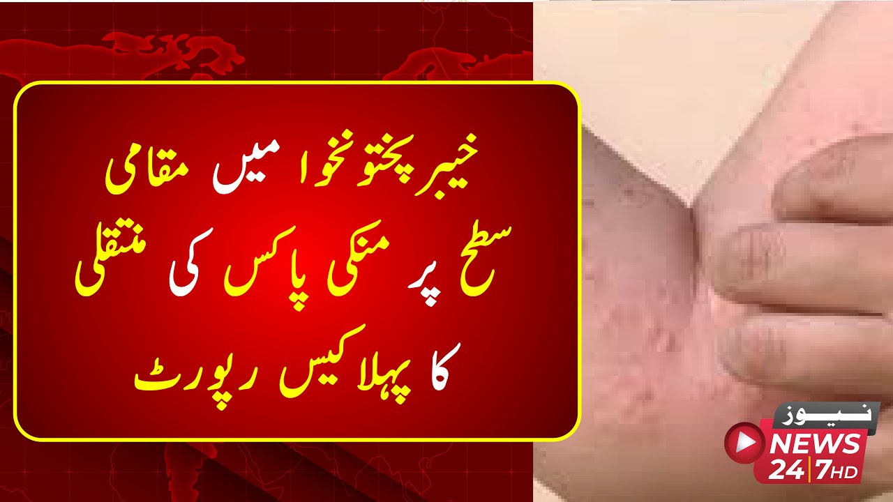 First case of local transmission of monkeypox reported in Khyber ...