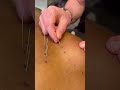 Dry Needling