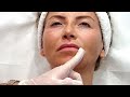 Op Dr Aysun BГ LГјkbaЕџД Mamak Ile 3 Seans Bioregen UygulamasД Alkali Multi Fraksiyonel HA Op Dr Aysun BГ LГјkbaЕџД Mamak Ile 3 Seans Bioregen UygulamasД Alkali Multi Fraksiyonel HA