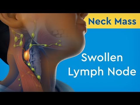 Neck Mass: Swollen Lymph Node