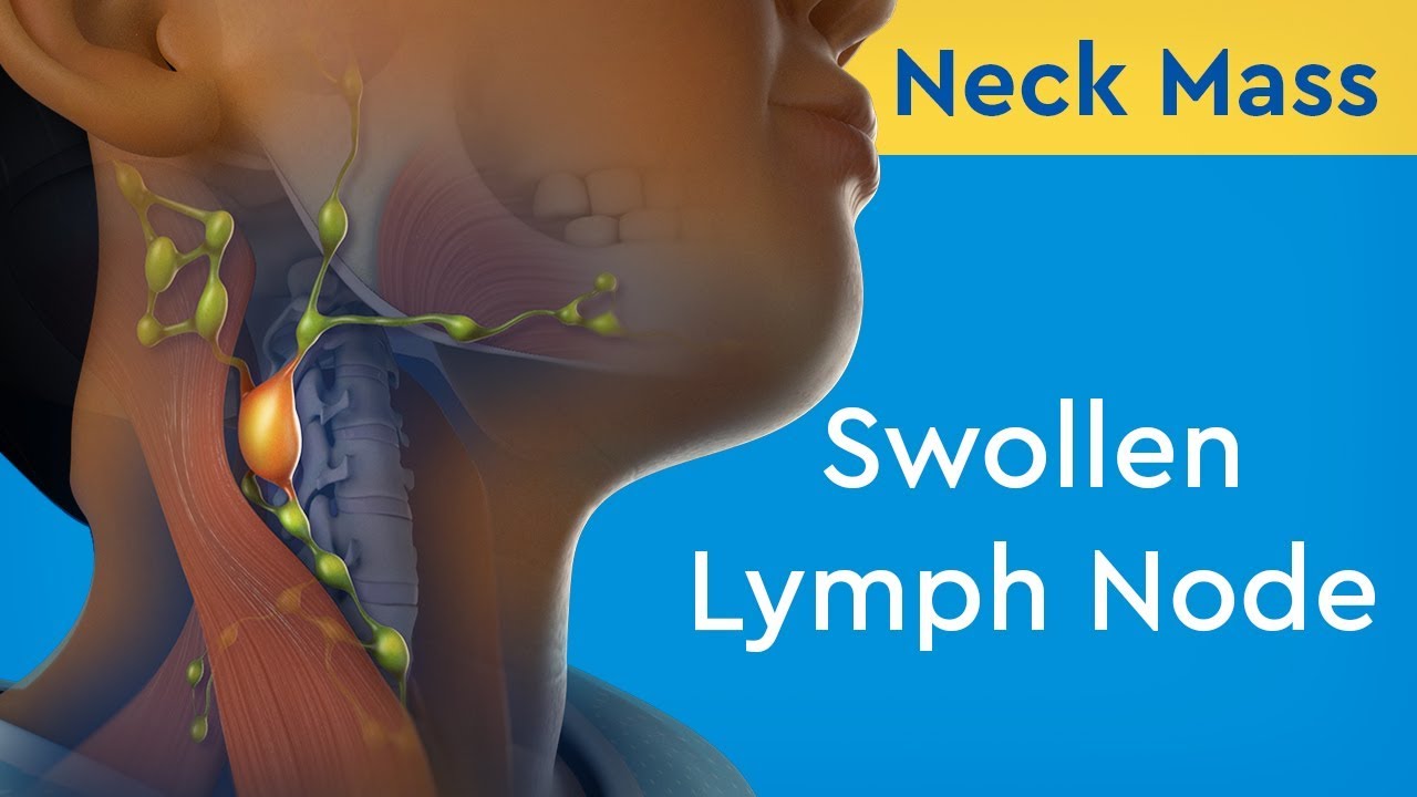 Lymph remedies nodes swollen for 32 Great