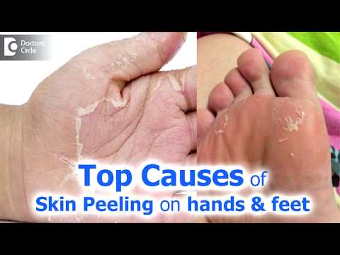 हाथों और पैरों पर त्वचा का छिलना - कारण और उपचार डॉ. राजदीप मैसूर