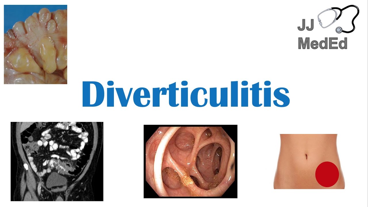 Diverticulitis: Risk Factors (ex. Low Fiber Diets),... - youtube