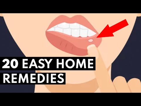 Video: Eenvoudige manieren om neuszweren te genezen: 8 stappen (met afbeeldingen)