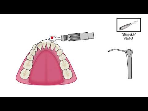 Ortho-FlexTech Fixed Lingual Retention Wire