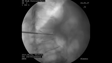 Vertebroplasty in osteoporotic vertebral compression fractures – Video abstract [555086]