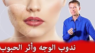 طريقة التخلص من أثار حب الشباب.