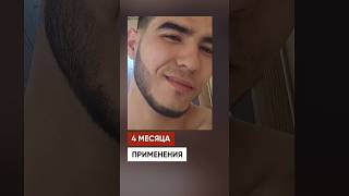 Борода с нуля за 5 месяцев. Результаты средства Mr.Volos