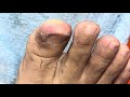 Ep_6573 Big ingrown toenail removal 👣 ซ่อนตัวได้มิดชิด 😄 (clip from Thailand)