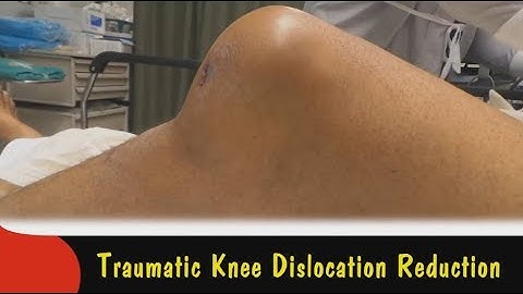 Traumatic Knee Dislocation Reduction