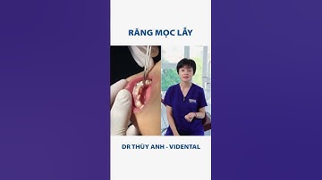 Răng mọc lẫy | Nha Khoa ViDental #nhakhoa #nhasi #rangmoclay #rangmieng #fyp #xuhuong #vidental
