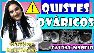 TODO sobre los QUISTES OVARICOS, Causas, Tratamiento, por GINECOLOGA DIANA ALVAREZ