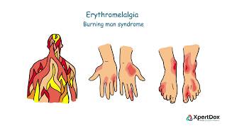 What is Erythromelalgia?