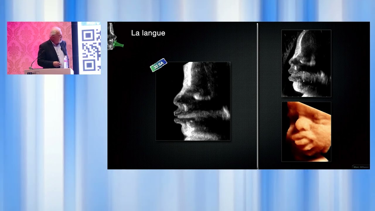 Les Journées d'échographie Septembre 2024: La face Fœtale du normal au pathologique : Dr Marc