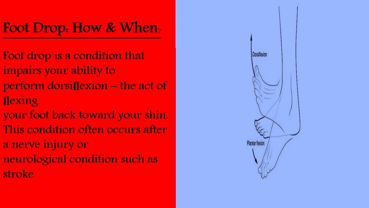 Foot drop , it's causes and treatment. YouTube
