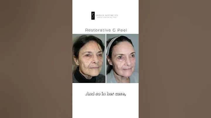 How to Get Rid of Smoker Lines: Dr. Grover on the Best Non-Surgical & Surgical Solutions