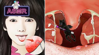 Asmr Ağız Taşları, Stoma, Dil Iğneleri, Bademcik Iltihabı Animasyonu Asmr4K