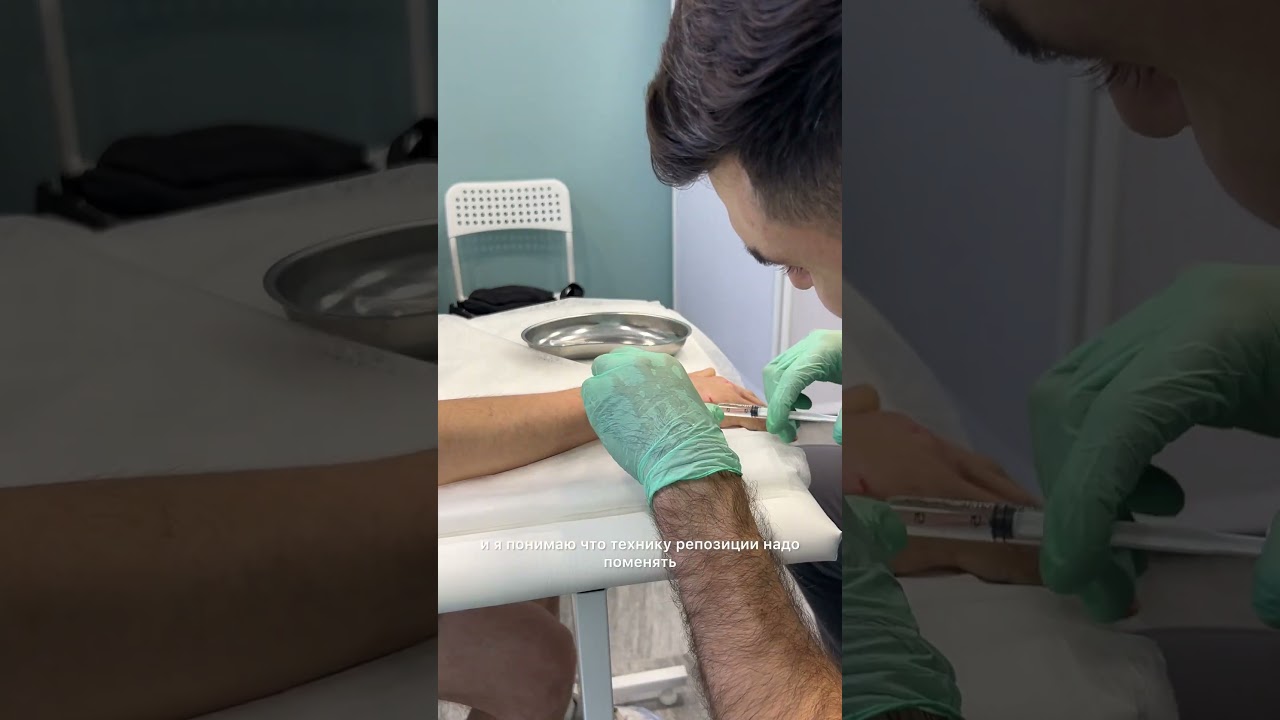 Лечение перелома пястной кости без операции в Барнауле. Репозиция пястной кости