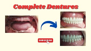 Processing of Complete Dentures | Complete Dentures Steps | Full teeth replacement |  CD |