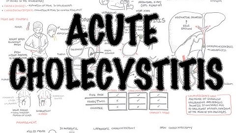 Acute Cholecystitis - Overview (signs and symptoms, pathophysiology, treatment)