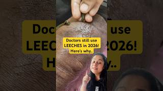 Hi Doctors Still Use Leeches in 2026. Here’s Why