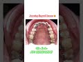 😍Wow ! Amazing lingual braces #advanced #braces #invisalign #hyderabaddentist #shorts #dentist