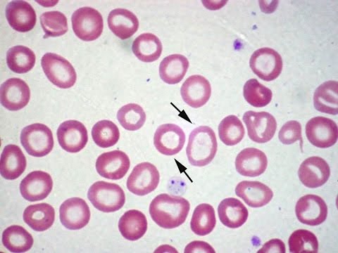 Video: Hematolog - Konsultasjon, Diagnose, Anmeldelser