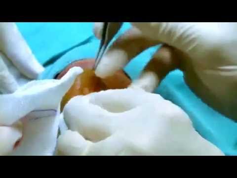 Video: Una Revisione Sistematica Dei Margini Chirurgici Utilizzati Per La Rimozione Dei Tumori Dei Mastociti Cutanei Nei Cani