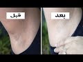 كيف أتخلص من سواد الإبط في ثلاثة أيام طريقة مجربة ومضمونة