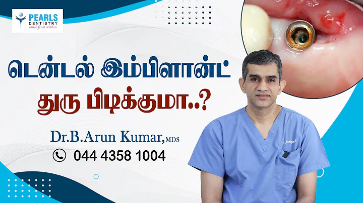Will dental implants rust..? -  Pearls Dentistry - Dr.Arun Kumar
