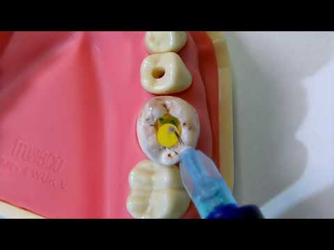 OdneFill Bubble Removal from the Pulp Chamber - video from Odne