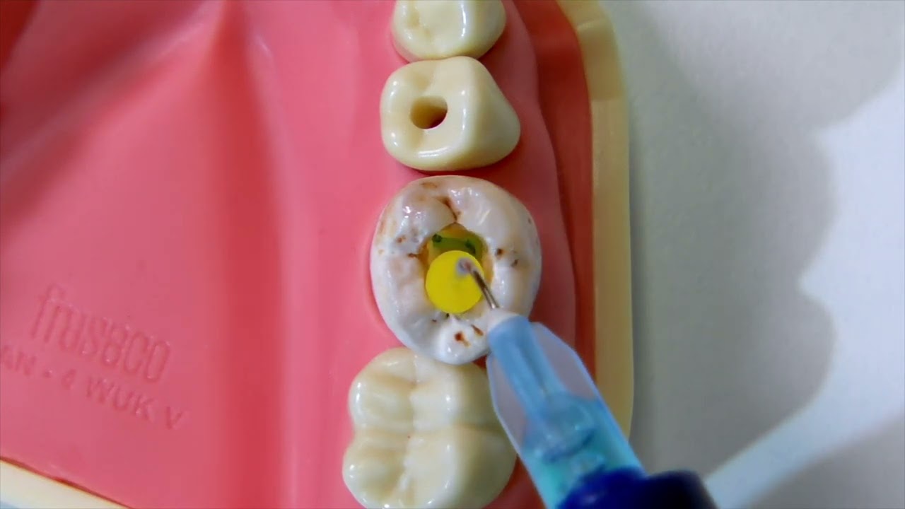 OdneFill Bubble Removal from the Pulp Chamber