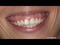 Tratamiento Sonrisa Gingival: ¿Camuflaje o Cirugía? Gummy Smile: a surgical approach?