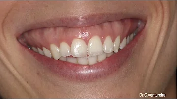 ¿Cómo corregir gummy smile?