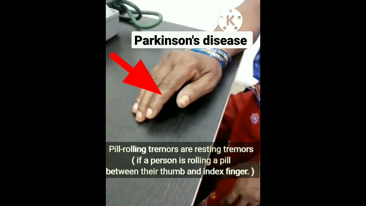 Pill rolling Tremors Parkinson s Disease YouTube Pill rolling Tremors Parkinson s Disease YouTube