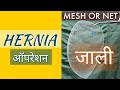 Hernia Treatment - 3D Mesh