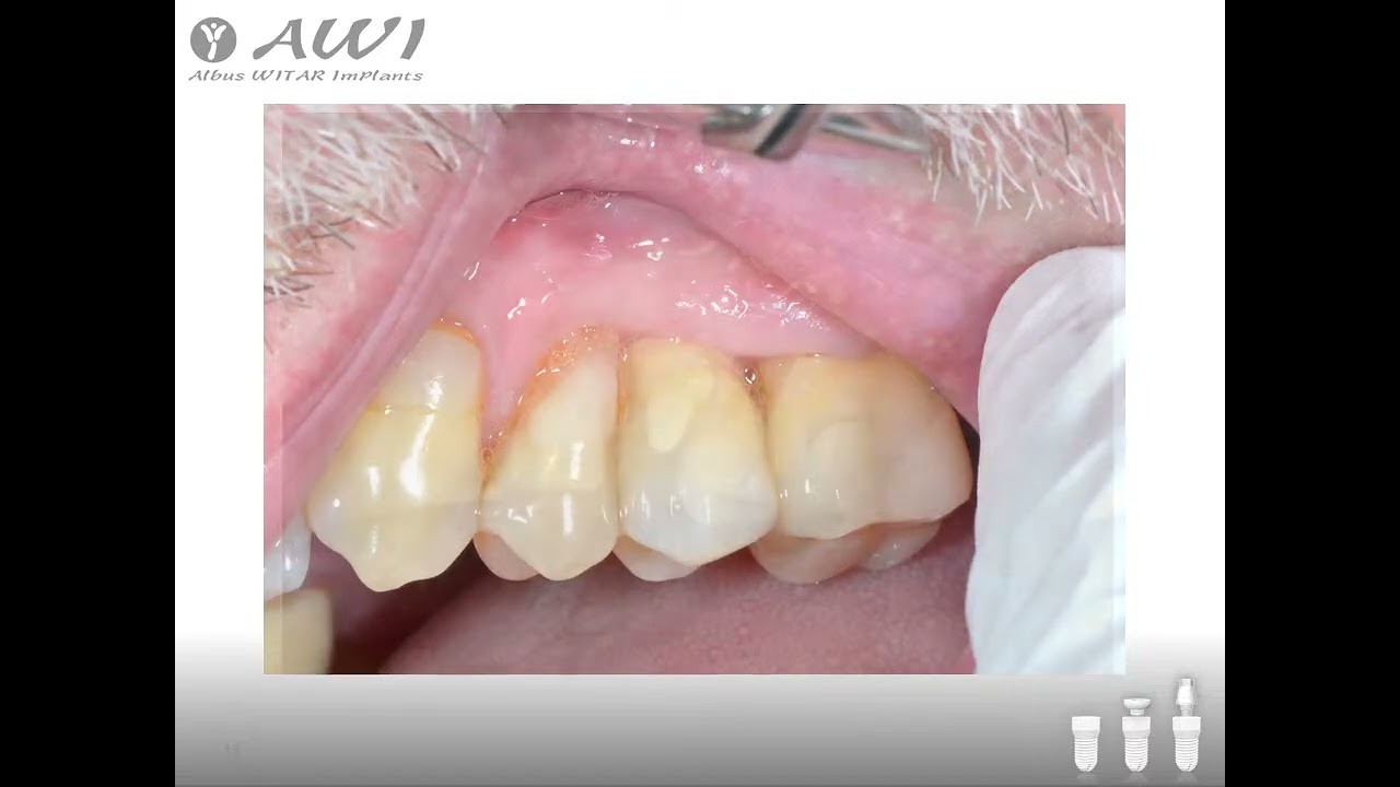 Протезирование с использованием циркониевых имплантатов AWI