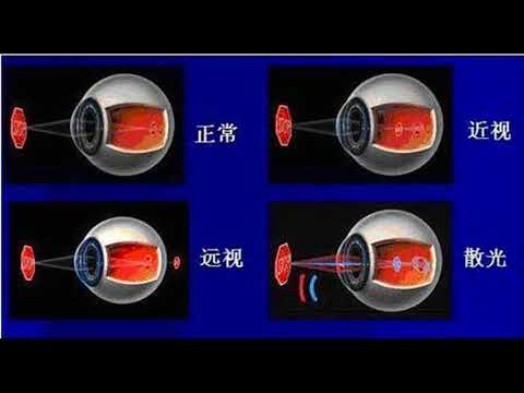 孩子眼睛有散光？家長看后都這樣做！