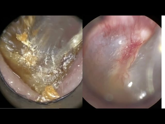 141 - Very Impacted & Stubborn Dead Skin Plugs Extracted from Ear using WAXscope®️ class=