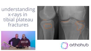 Ep.1: orthohub ODM: understanding x rays in tibial plateau fractures - orthopaedic surgeon education