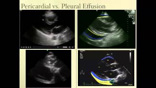 Pericardial Effusion Ultrasound Review