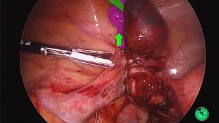 Laparoscopic Salpingectomy: Tubal Ectopic Pregnancy by Migs_Tips
