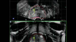 Images From TransRectal Prostate Biopsy | Urology Videos |